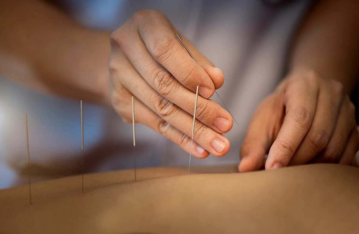 Close-up of an acupuncture treatment